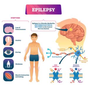 Read more about the article Epilepsy